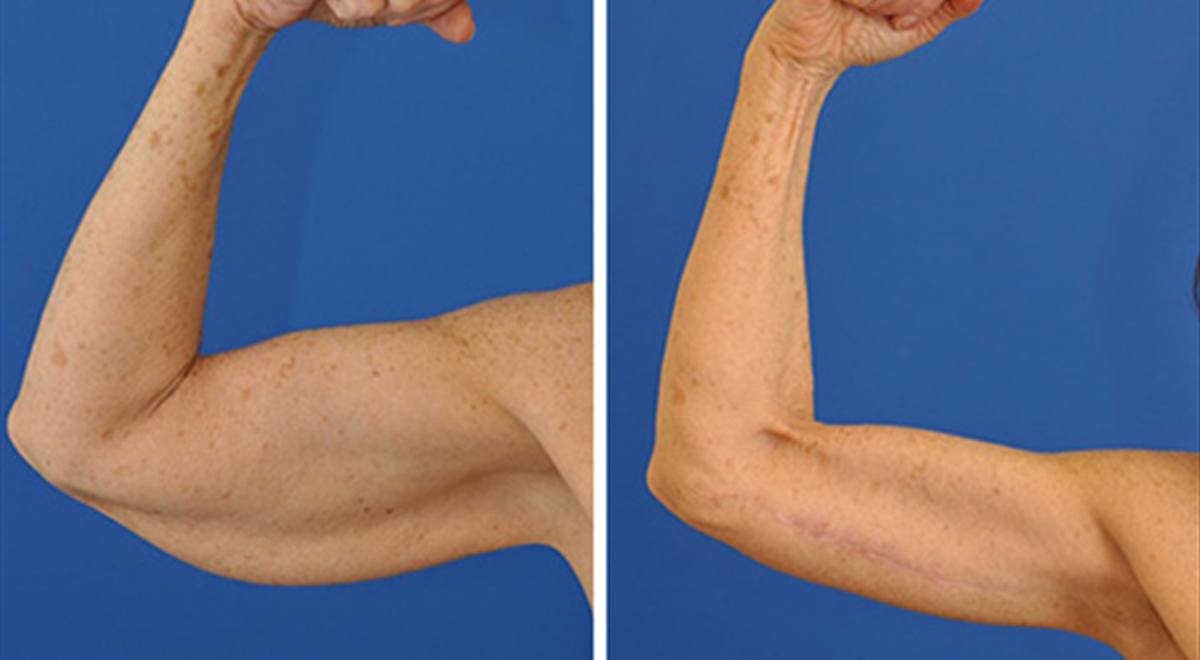 Arm lift brachioplasty upper arm contouring before and after results near me Cape Town - Dr Maresky US Board Certified cosmetic surgery