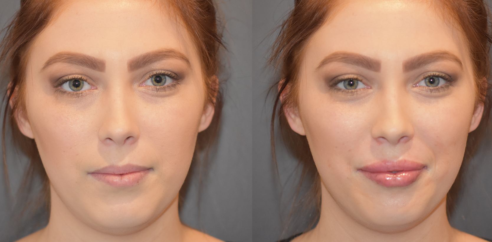 Lip fillers lip augmentation enhancement before and after results near me Cape Town - Dr Maresky US Board Certified cosmetic surgery