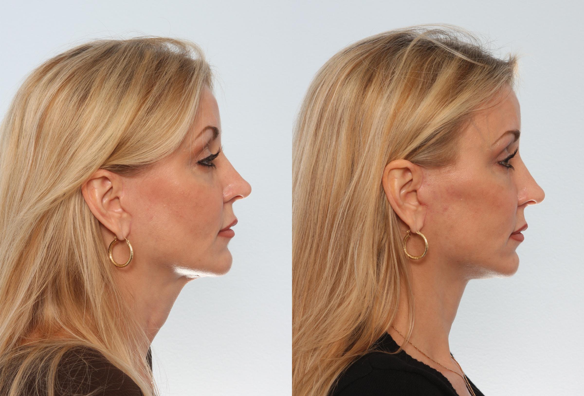 Neck lift cervicoplasty neck contouring before and after results near me Cape Town - Dr Maresky US Board Certified cosmetic surgery