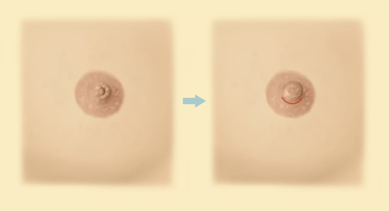 Nipple surgery areola reduction before and after results near me Cape Town - Dr Maresky US Board Certified cosmetic surgery