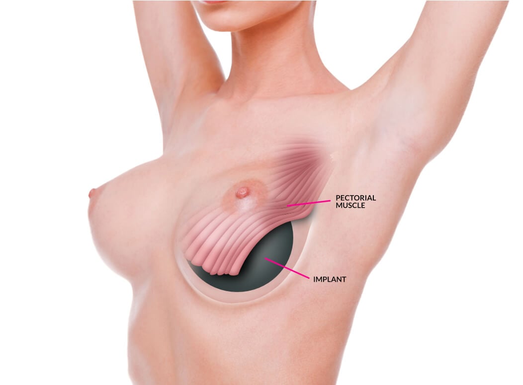 Breast Enlargement (Augmentation Mammoplasty) thumbnail 4