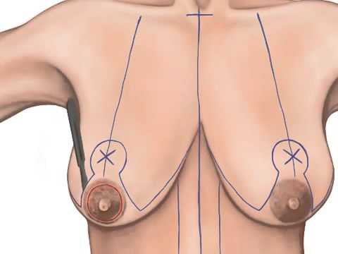 Breast Lift (Mastopexy) thumbnail 4