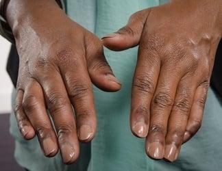 Carpal Tunnel Surgery (Carpal Tunnel Release) thumbnail 3