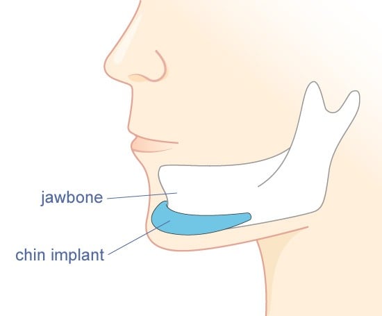 Chin Augmentation (Mentoplasty) thumbnail 4
