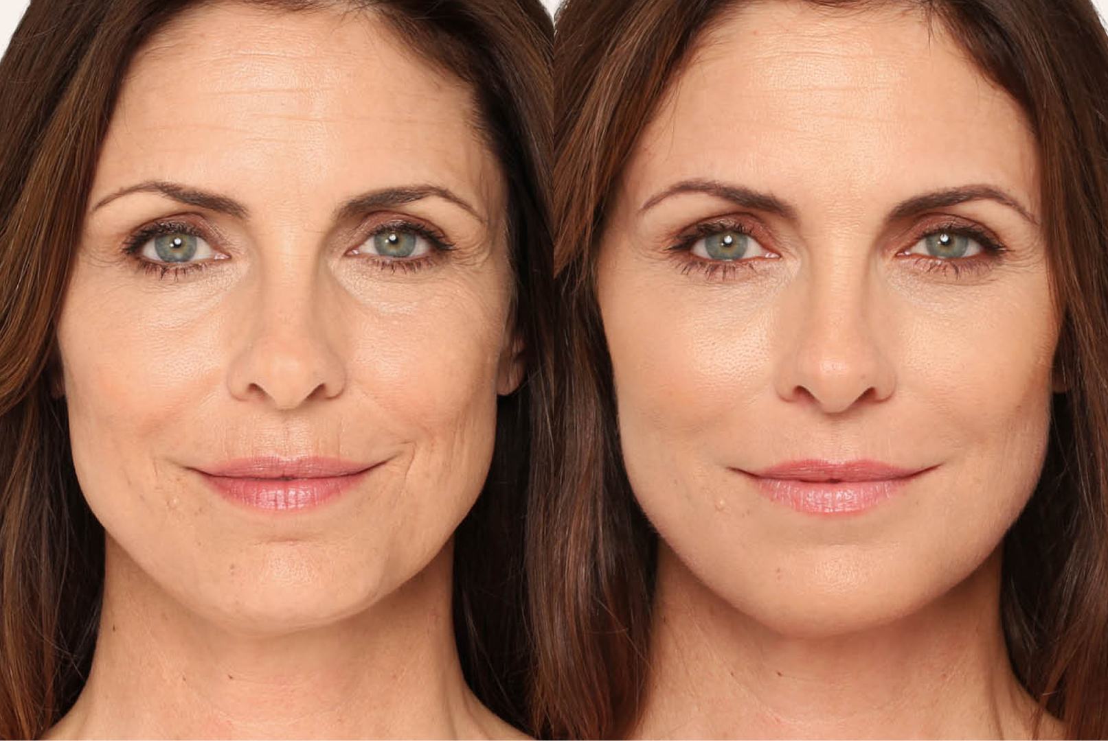 Facial Fillers (Dermal Filler Injections) thumbnail 4