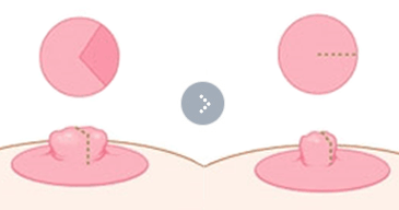 Nipple Surgery (Nipple Correction) thumbnail 3