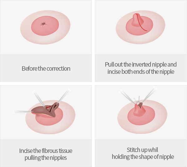Nipple Surgery (Nipple Correction) thumbnail 2