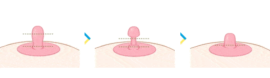 Nipple Surgery (Nipple Correction) thumbnail 4