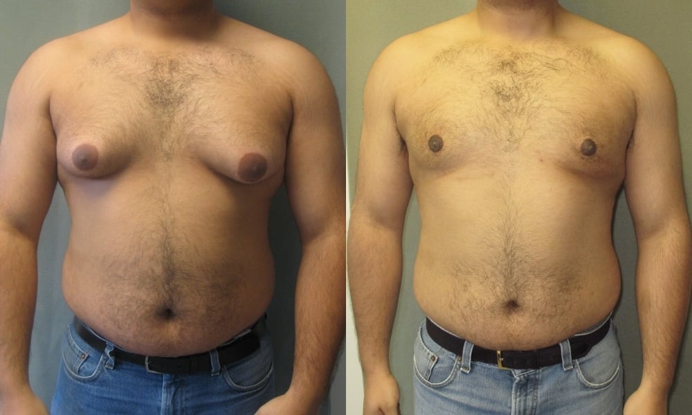 Male breast reduction gynecomastia surgery before and after results near me Cape Town - Dr Maresky US Board Certified cosmetic surgery