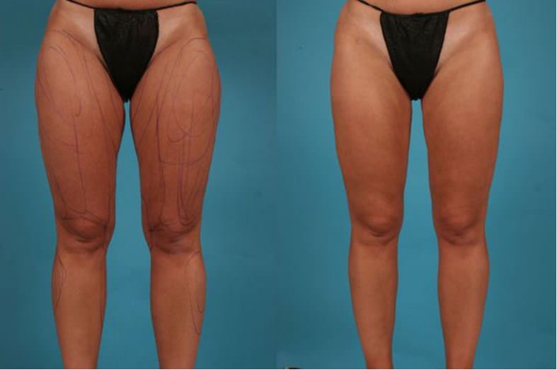 Thigh lift surgery leg contouring before and after results near me Cape Town - Dr Maresky US Board Certified cosmetic surgery