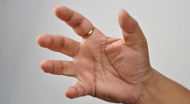 Trigger Finger (Tenolysis) thumbnail 4