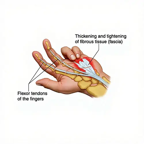 Dupuytren's Contracture (Fasciectomy) - Dr. Gideon Maresky Cape Town