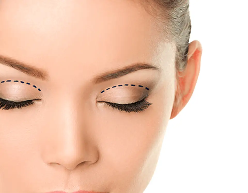 Eyelid Lift (Blepharoplasty) - Dr. Gideon Maresky Cape Town