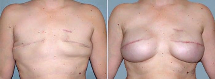 Breast reconstruction post-mastectomy surgery before and after results near me Cape Town - Dr Maresky US Board Certified cosmetic surgery