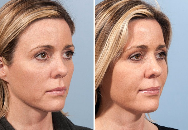 Fat transfer grafting lipo fills natural volume restoration before and after results near me Cape Town - Dr Maresky US Board Certified cosmetic surgery