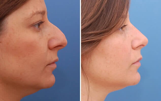 Nose job rhinoplasty before and after results near me Cape Town - Dr Maresky US Board Certified improved nasal shape and profile