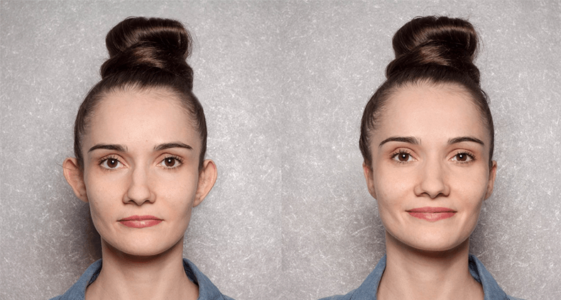 Otoplasty ear pinning ear reshaping before and after results near me Cape Town - Dr Maresky US Board Certified cosmetic surgery