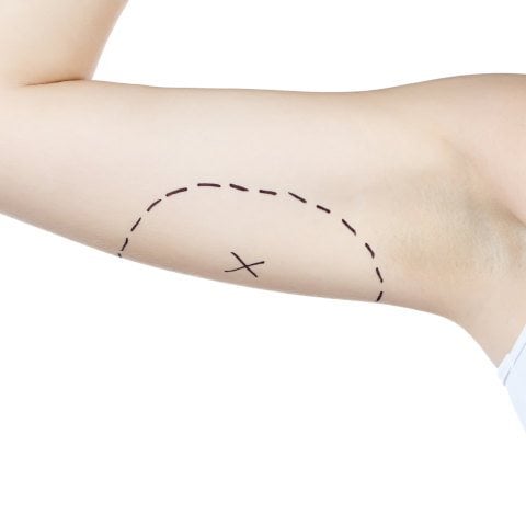 Arm Lift (Brachioplasty) - Image 4 of 4