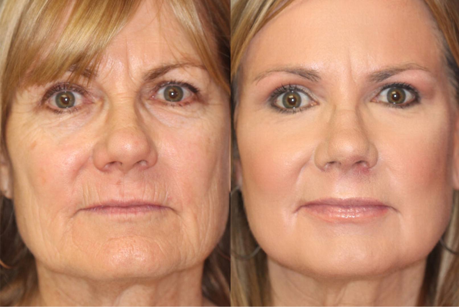 Chemical Peels (Chemexfoliation) before and after