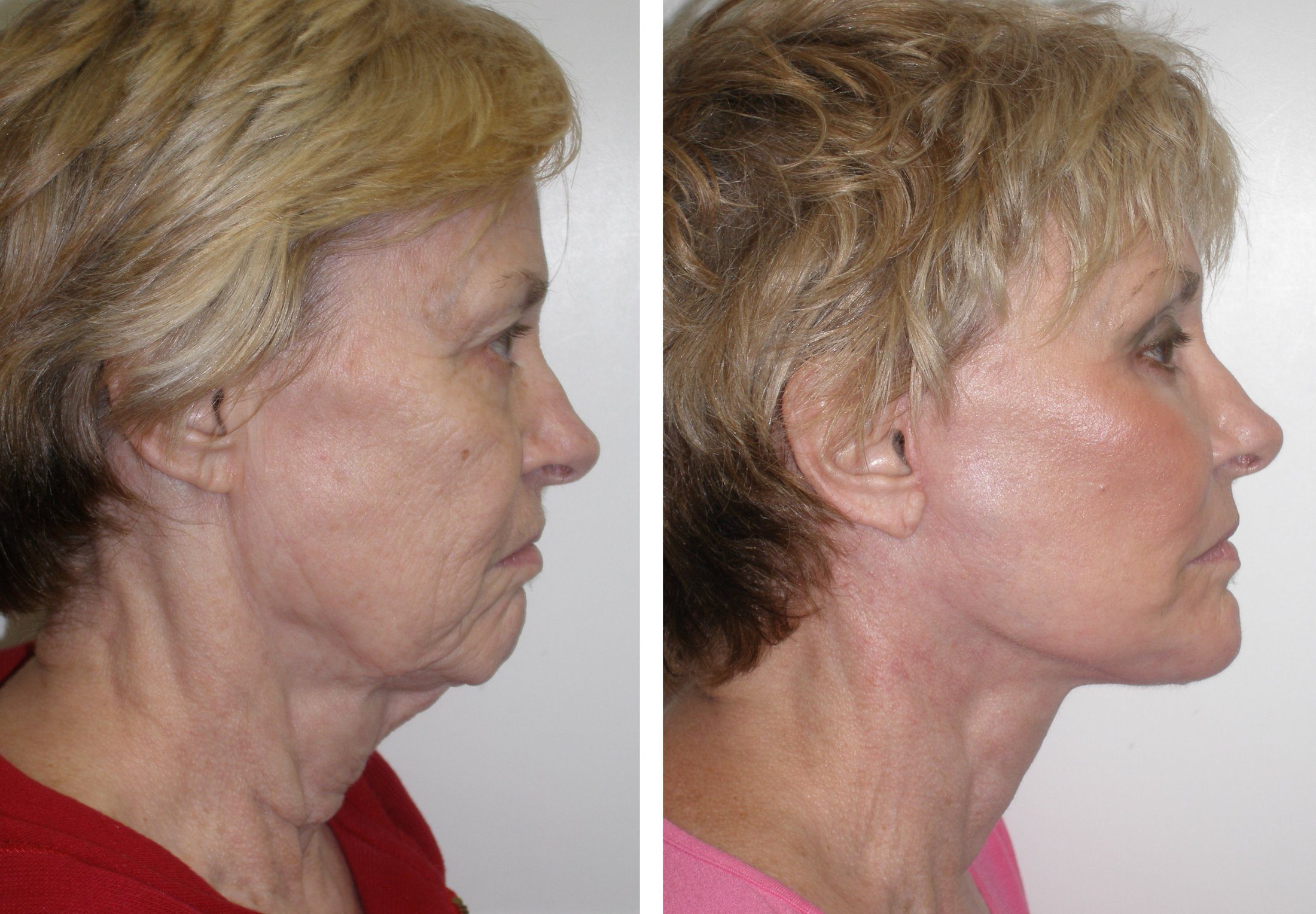Facelift (Rhytidectomy) before and after