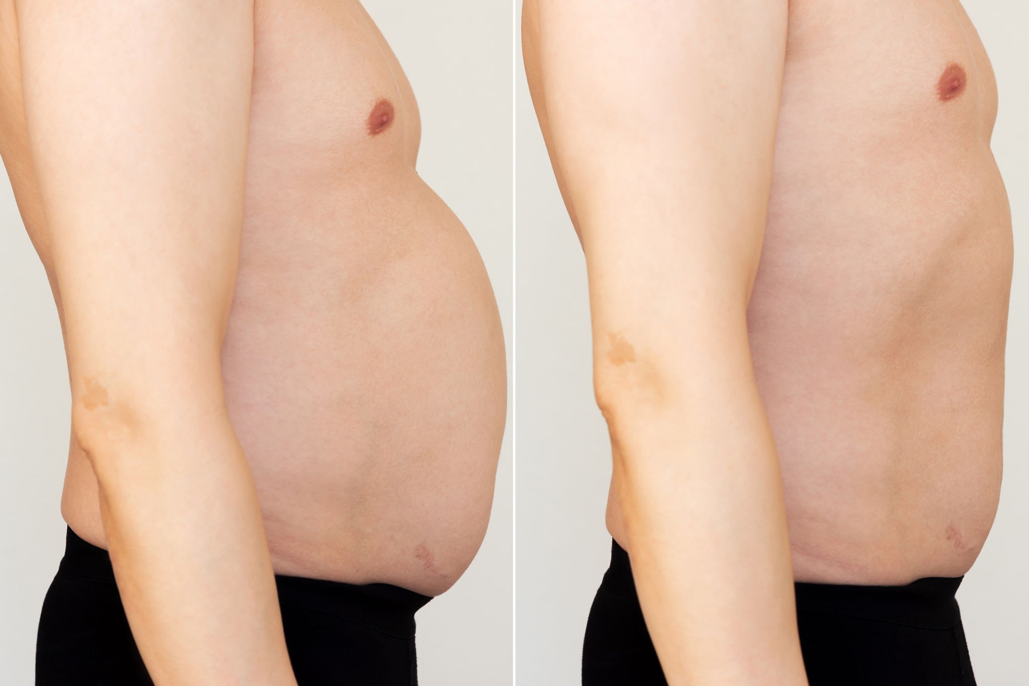 Liposuction (Lipoplasty) before and after