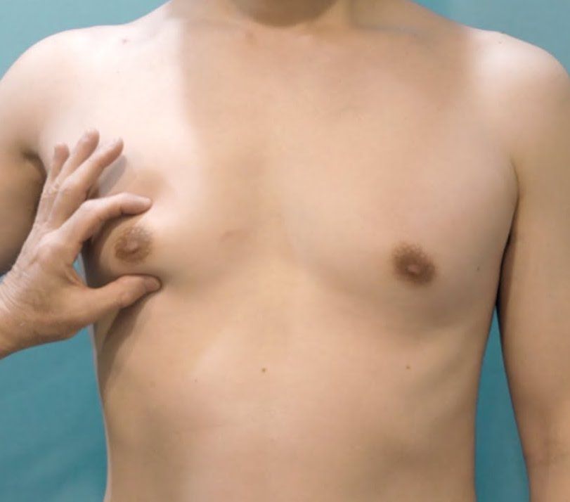 Male Breast Reduction (Gynecomastia Surgery) - Image 4 of 4