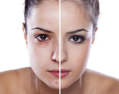 Microdermabrasion (Mechanical Exfoliation) - Image 4 of 4