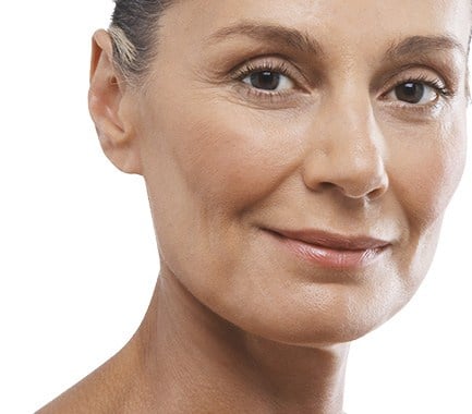 Neck Lift (Platysmaplasty) - Image 3 of 4