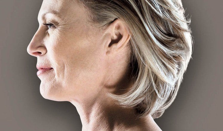 Neck Lift (Platysmaplasty) - Image 4 of 4