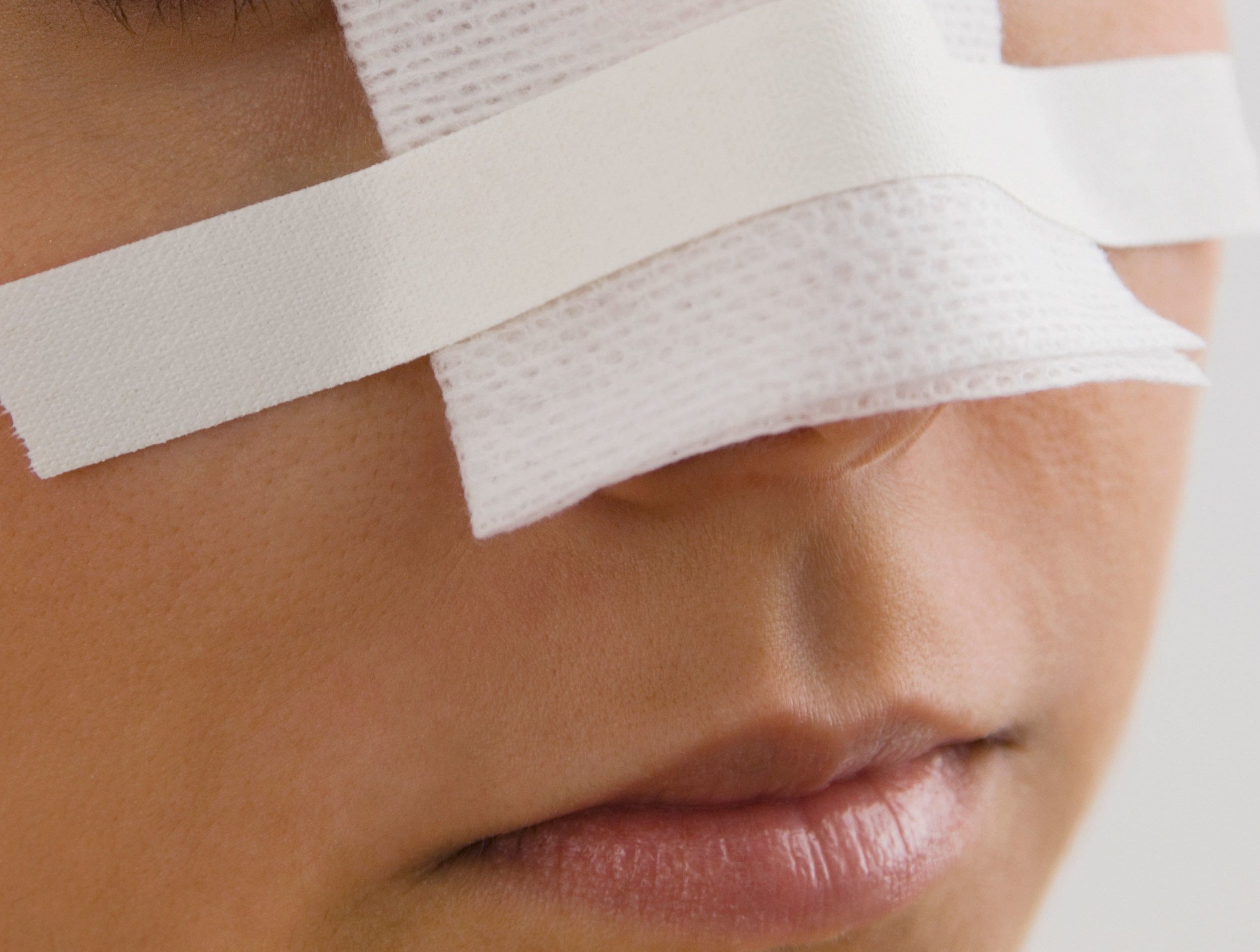 Nose Job (Rhinoplasty) - Image 4 of 4