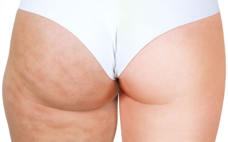 Thigh Lift (Thighplasty) - Image 3 of 5