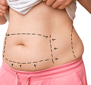 Tummy Tuck (Abdominoplasty) - Image 4 of 6