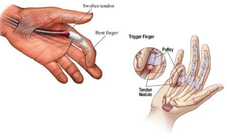 Trigger Finger (Tenolysis) thumbnail 5
